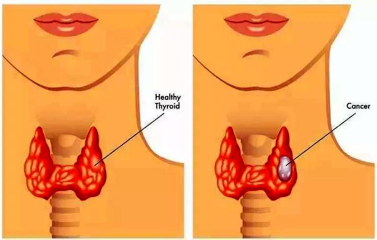 1627525110133342.jpg 甲状腺样子.jpg